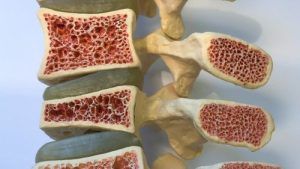 La Osteoporosis: 5 Métodos para Combatirla sin Medicación