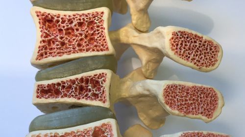 fractura por osteoporosis tratamiento con fisioterapia y resonancia MBST en Valencia y Gandía Comunidad Valenciana