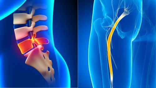 que es la ciática clinica de fisioterapia estenosis de canal